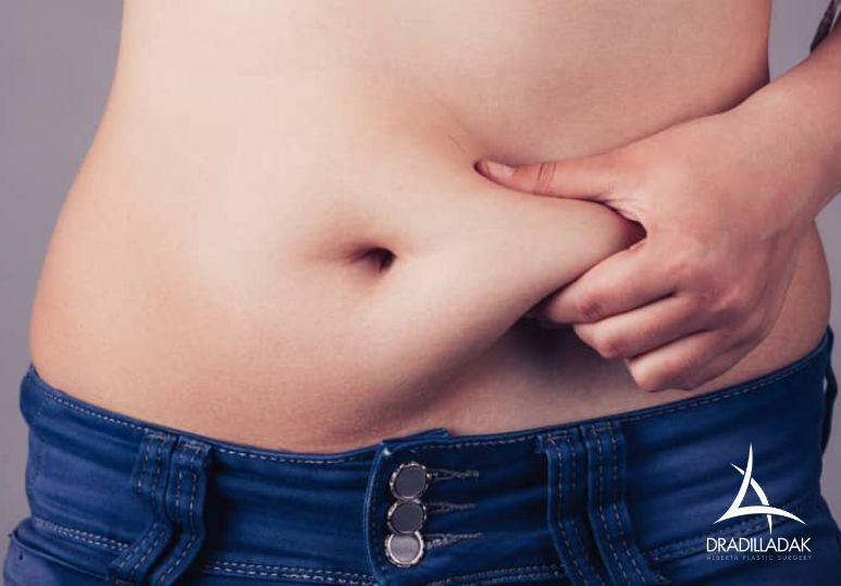 When A Tummy Tuck Might Not be Right For You